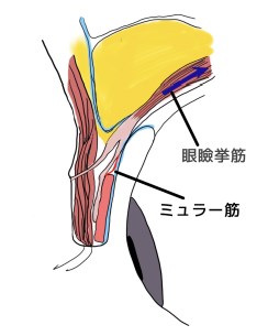 【画像】眼瞼下垂