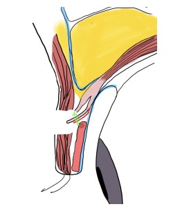 【画像】眼瞼下垂