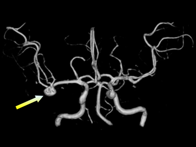 MRAで左中大脳動脈瘤を認めた（矢印）