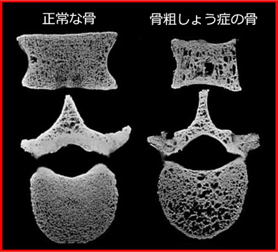 骨粗しょう症の症例写真